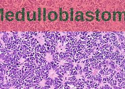 Image result for Medulloblastoma in Children