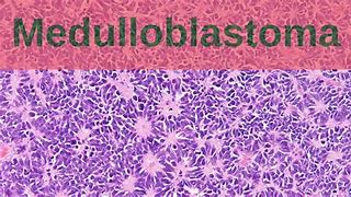 Image result for Medulloblastoma Location Diagram