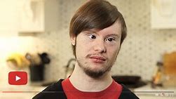 Image result for Down Syndrome Look Like