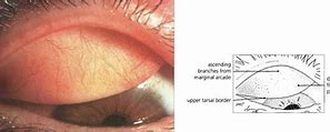 Image result for Tarsal Conjunctiva Papillae