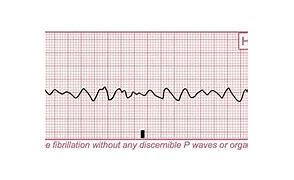 Image result for V-fib Heart Strip