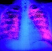 Image result for Miliary Tuberculosis Chest X-ray