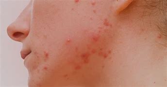 Image result for Viral Pustules