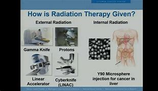 Image result for Radiotherapy Rectal Cancer