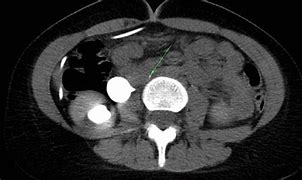 Image result for Retrocaval Ureter X-ray