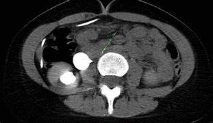 Image result for Postcaval Ureter