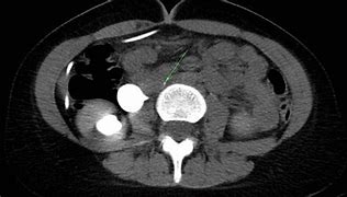 Image result for Retrocaval Ureter vs Normal