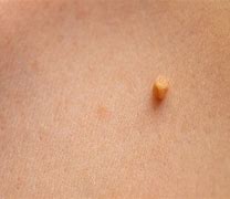 Image result for Benign Skin Bumps