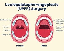 Image result for Sleep Apnea Surgery