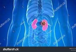 Image result for Kidney Cancer Tumor