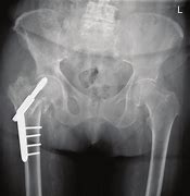 Image result for Orif Hip