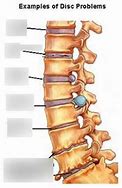 Image result for Spinal DIC Chart