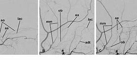 Image result for Dorsal Nasal Artery