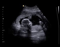 Image result for 3 Month Pregnancy Ultrasound