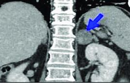 Image result for Pheochromocytoma CT Abdomen