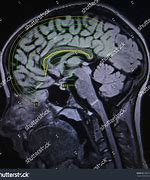 Image result for Seizure On MRI