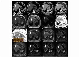 Image result for Tace Ablation