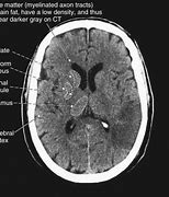 Image result for CT Brain Lentiform Nucleus