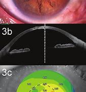 Image result for Corneal Perforation