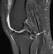 Image result for Avulsion Fracture