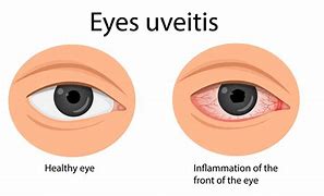 Image result for Uveitis Vision