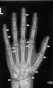 Image result for Bone Age Hand X-ray