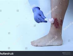 Image result for Ankle Wound