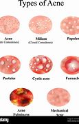 Image result for Large Acne Pustules