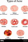 Image result for Infected Acne Pustules