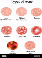 Image result for What Are Pustules On the Skin