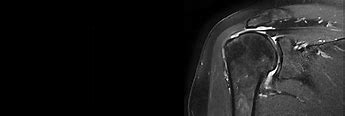 Image result for Shoulder MRI