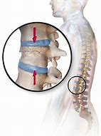 Image result for Compression Fracture Lumbar Surgery