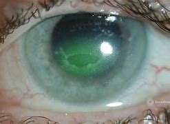 Image result for Corneal Defect