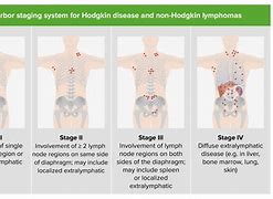 Image result for Hodgkin Lymphoma Cancer Symptoms