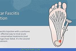 Image result for Plantar Fascia Steroid Injection