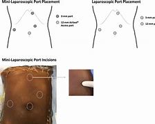 Image result for Ports for Lap Chole