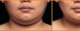 Image result for CoolSculpting Chin Before and After