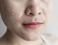 Image result for Hard Sebum in Pores