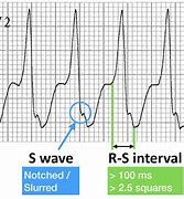 Image result for SVT vs VT ECG