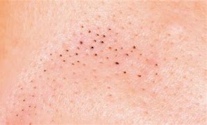 Image result for Remove Blackheads