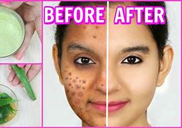 Image result for How to Prevent Pimples On Face