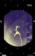 Image result for Kidney On X-ray