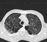 Image result for Bullous Emphysema X-ray