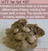 Image result for Teratoma