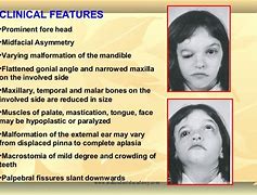 Image result for Malar Hypoplasia