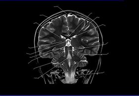 Image result for Coronal Plane Brain MRI