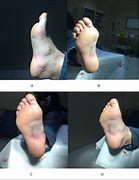 Image result for Plantar Fascia Rupture