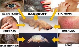 Image result for Demodex Mite Infestation