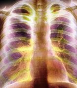 Image result for Bullous Emphysema X-ray