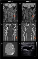 Image result for Spiral Dissection ICA